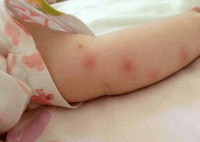 婴儿被蚊子咬了怎么消肿?蚊子对婴幼儿的危害